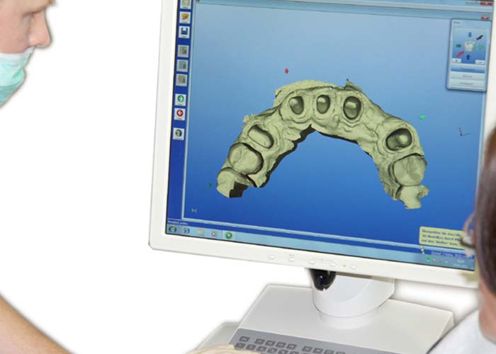 Digitaler Workflow bei Rißmann Zahntechnik: Bei der digitalen Abformung digitalisiert der Zahnarzt mit einem Intraoralscanner die Zähne und transferiert die Daten ans Labor.