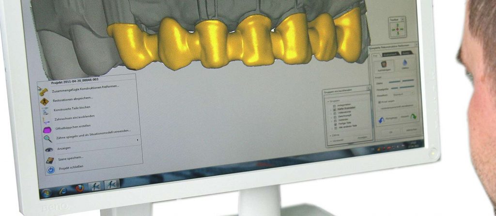 Implantatprothetik: Bei der Implantatplanung unterstützt Rißmann Zahnärzte mit der modernen Implantatplanungssoftware codiagnostix.