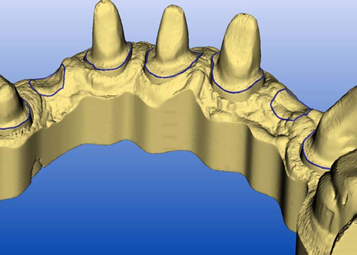 Digitaler Workflow bei schwandental Zahntechnik: Das Errechnen eines virtuellen Modells erfolgt automatisch.